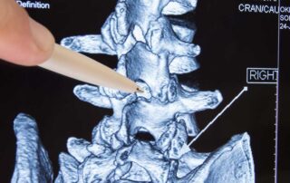 Radiculopathy